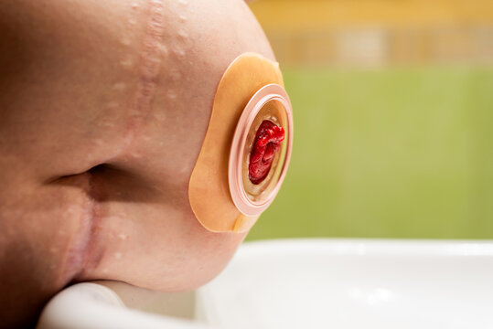 Abdomen of a woman with a clean stoma and a newly changed base plate ready to attach the ostomy bag