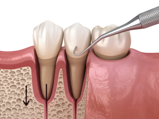 Dental probe examining gum recession on teeth isolated on transparent background