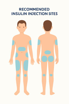 Flat vector diagram showing recommended insulin injection sites on human body