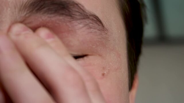 Child scratching eye with irritated skin due to allergy