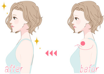 巻き肩を整える女性の横顔ビフォーアフター