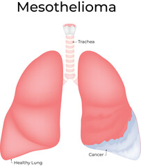Mesothelioma Lung Cancer Diagram Vector Illustration