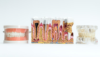 Dental Models Showing Full Denture, Tooth Anatomy, and Jaw Implants