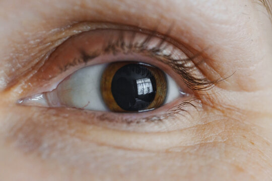 Dilated pupil after eye drops with light reflection