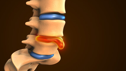 Spinal Disc Herniation Shown in Medical Animation