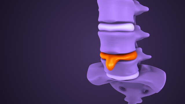 Medical Video of Spinal Disc Herniation Process
