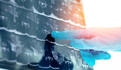 Mri scan of spine with disc protrusion highlighted by gloved hand