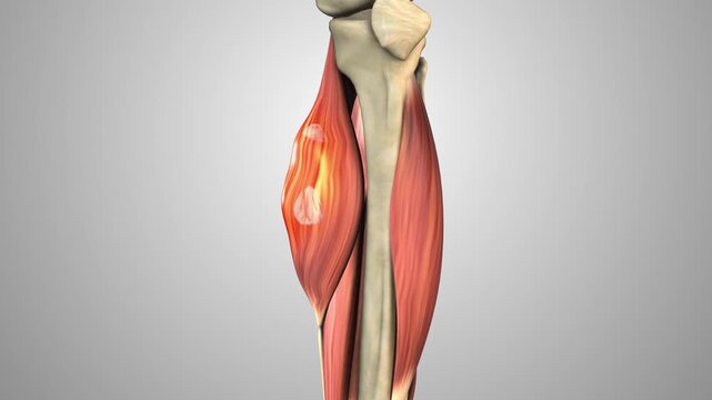 Malignant Soft Tissue Sarcoma in Leg