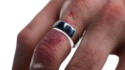 PNG of A close-up of a male hand showing a silver ring on a dry, irritated finger, highlighting skin texture and details.