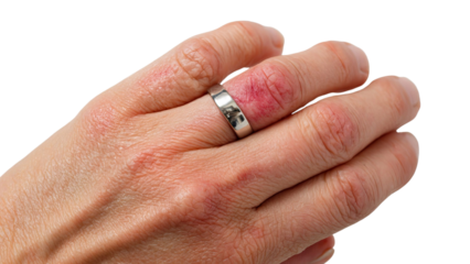 PNG of Close-up of a hand showing a silver ring with skin irritation around it, exemplifying the impact of jewelry on sensitive skin.