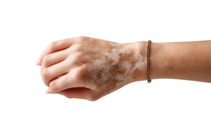 PNG of Close-up of a person's hand with vitiligo, showcasing unique skin patterns and a delicate bracelet.