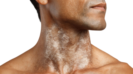 PNG of Portrait of a male with vitiligo, showcasing skin contrast on the neck area for an authentic representation of diversity.