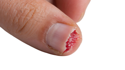 PNG of Close-up of a male hand showing a painful, cracked fingernail with red irritation around the cuticle.