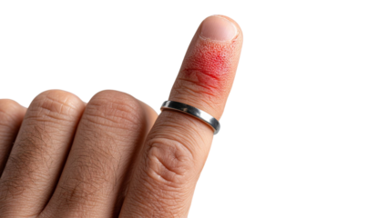 PNG of Close-up of a male hand showing a finger with a cut and a silver wedding band.