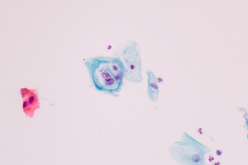 Abnormal human squamous epithelial cells view in microscopy.HPV criteria for pap smear slide cytology and pathology.Koilocyte cells on white background.Woman cervical cancer cell medical concept.