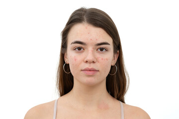 Portrait of young woman with acne on her face. Acne, skin care concept. Real photo.