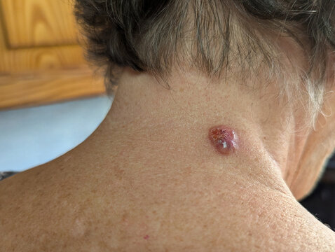 Close-up of basal cell carcinoma on nape of elderly woman. Skin cancer lesion caused by chronic sun exposure, dermatology and medical awareness concept. Healthcare, oncology, prevention.
