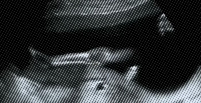 Close-up view of ultrasound monitor showing fetus image at three months of pregnancy