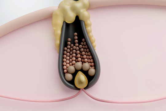 Clogged hair follicle with sebum buildup and dirt blocking hair growth 3d rendering