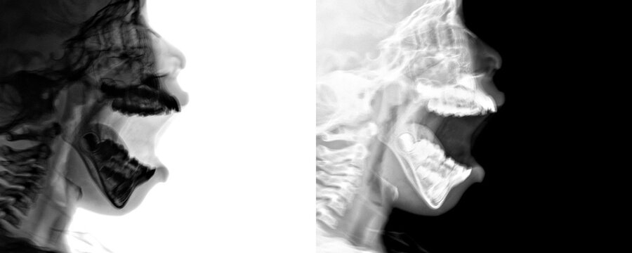 Nasopharynx Lateral View X-Ray Radiograph Highlighting Soft Tissue and Adenoid Hypertrophy for Diagnosis of Chronic Adenoiditis Isolated on Transparent Background