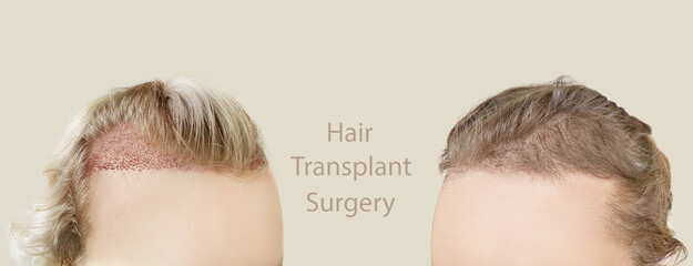 Hair Transplant Surgery.Hair Transplantation and Restoration