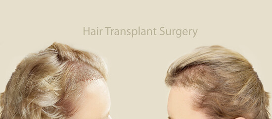 Hair Transplant Surgery.Hair Transplantation and Restoration