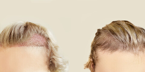 Hair Transplant Surgery.Hair Transplantation and Restoration