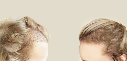 Hair Transplant Surgery.Hair Transplantation and Restoration