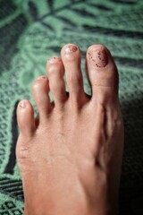 Toes with the following conditions on Black or Asian left foot under well-lit conditions - Mallet...