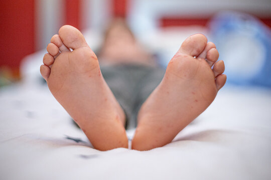 Child's feet showing hand foot and mouth disease rash