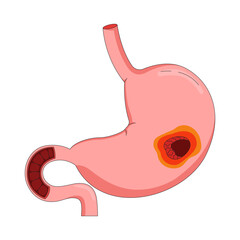 Human stomach with peptic ulcer 2D vector illustration. Anatomical organ inflammation. Digestive disease. Gastrointestinal tract wound flat object isolated on white background. Colorful cartoon image