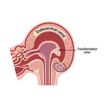 Detailed diagram illustrating the endocervical canal and transformation zone for medical education and research