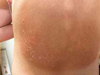 Fototapeta premium Peeling back sunburned skin on child shoulder after strong sun