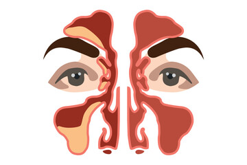 Illustration of human sinuses anatomy showing sinusitis inflammation and nasal cavity structure. EPS 10
