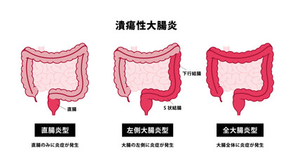 潰瘍性大腸炎の種類　ベクターイラストセット