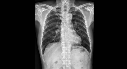Chest X-ray radiograph showing thoracic cavity with visible ribcage, spine, lungs, and skeletal structure in posteroanterior upright view. Medical diagnostic imaging for respiratory system evaluation 