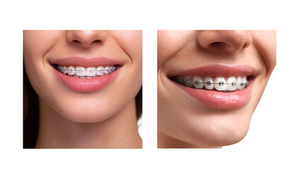 Close-Up Smiles of Young Women with Braces Showcasing Modern Orthodontic Treatment and Dental Care