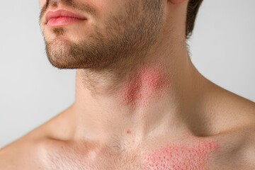 Fototapeta premium Closeup view of skin irritation on a man's neck and chest.
