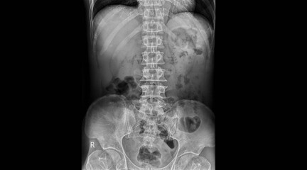 Lumbar spine X-ray radiograph showing lower back vertebrae, pelvis, and hip bones in anteroposterior view. Medical diagnostic imaging for spinal evaluation, disc assessment, and orthopedic examination