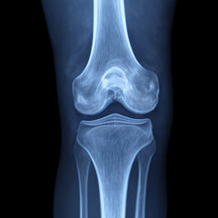 x ray image of knee joint