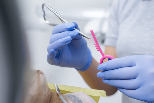 Gloved clinician picking orthodontic elastic ligature with instrument during braces adjustment