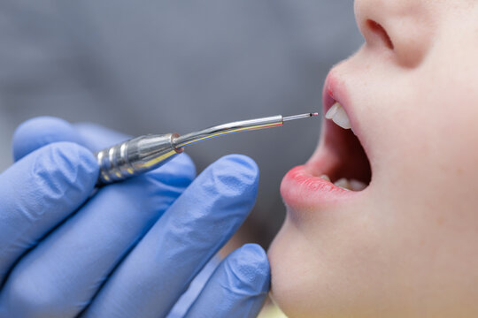 Pediatric diode laser near child mouth during soft tissue dental care, close up