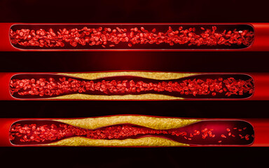 Artery narrowing due to cholesterol deposits, fast food intake, high-sugar beverages, alcohol addiction, and processed foods, emphasizing risks of hypertension, stroke, and cardiovascular death. 