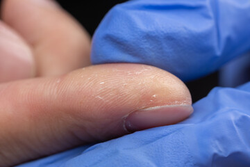 Dry, cracked, and damaged skin on fingers, Skin and nail health