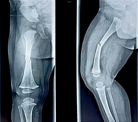 Pediatric femur X-ray showing displaced transverse fracture of femoral shaft