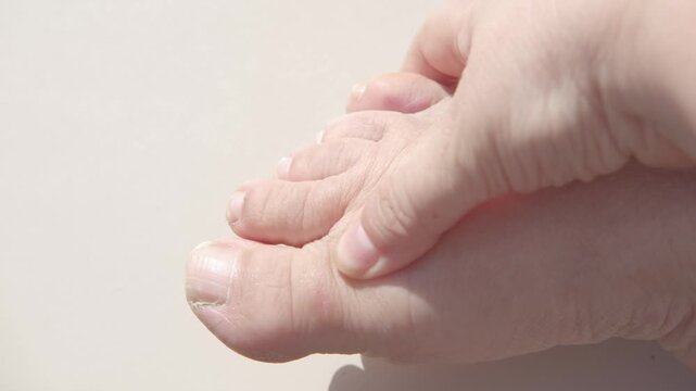 Senior female foot with purple bruise on small toe, orthopedic trauma, swelling, fracture risk, healthcare, accident, medical treatment, toe injury, pain and discomfort from hitting furniture