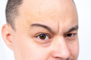 Closeup portrait Angry man with brown eyes and shaved head, man 35 years old expressing stress and frustration, aggressive reacting with anger and tension, natural skin texture, human forehead