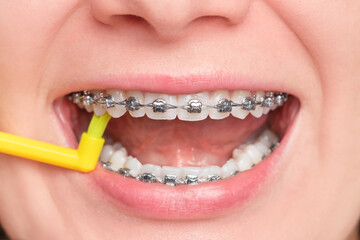 A young woman cleans her braces with a special toothbrush with her mouth open. Concept of oral dental health care and hygiene. Shallow depth of field