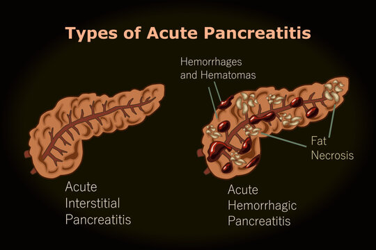 Types of Acute Pancreatitis, Hemorrhages and Hematomas, Fat Necrosis

