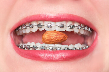 Close-up of a woman eating, biting an almond nut with metal bracket system on the teeth of a young woman. Concept of oral dental health care and hygiene . Shallow depth of field